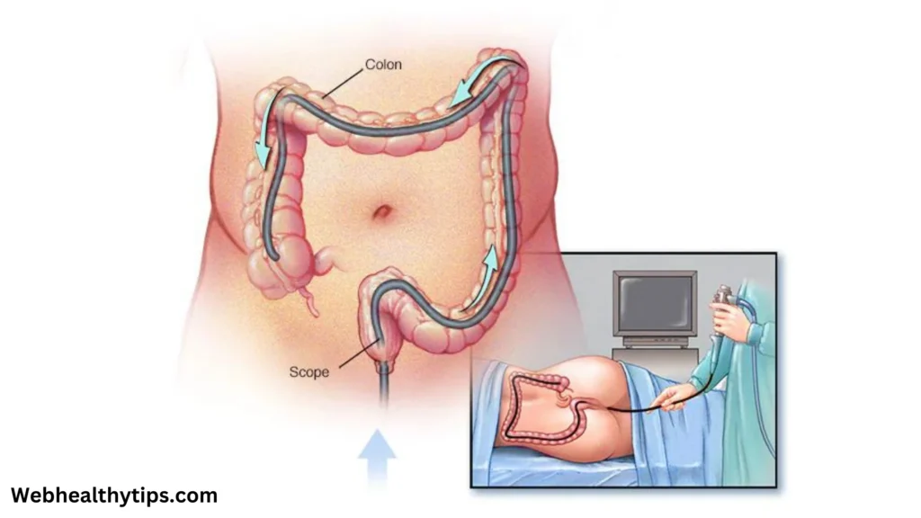 colonoscopy 